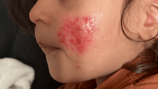 Healing your childs eczema naturally: a Mothers guide to holistic relief - Aafiyah Wellness Clinic