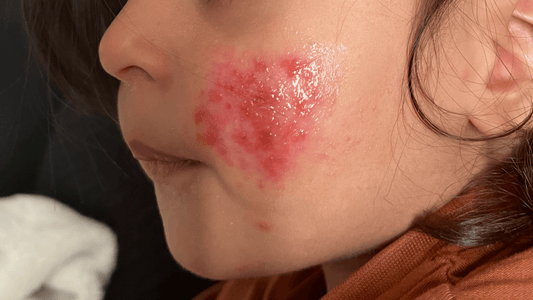 Healing Your Child's Eczema Naturally: A Mother's Guide to Holistic Relief - Aafiyah Wellness Clinic