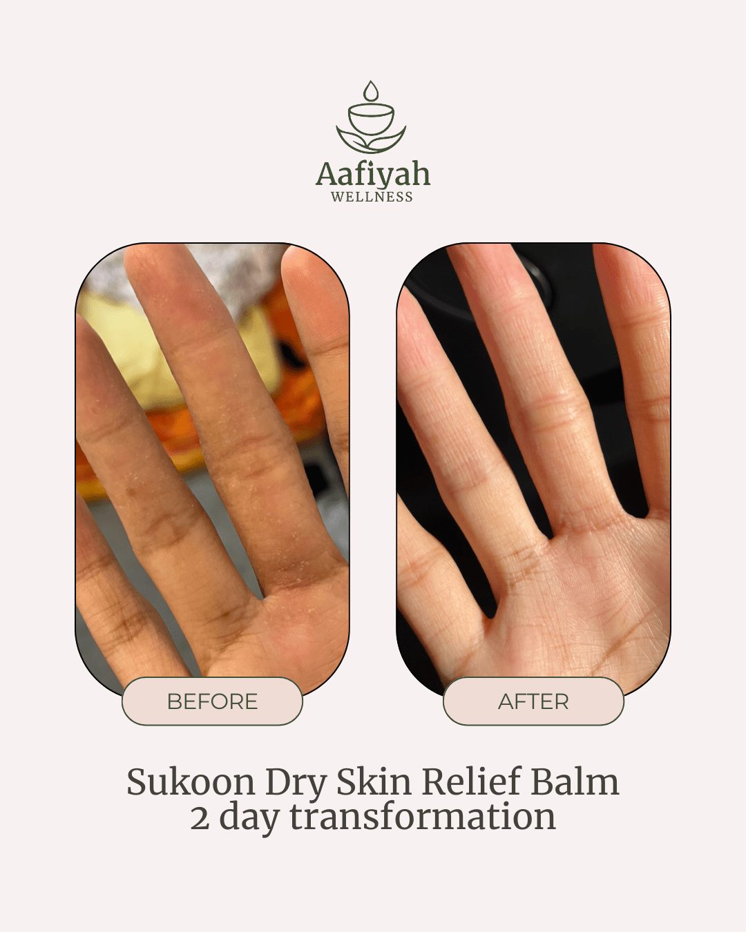 Sukoon Dry Skin Relief Balm - Aafiyah Wellness Clinic
