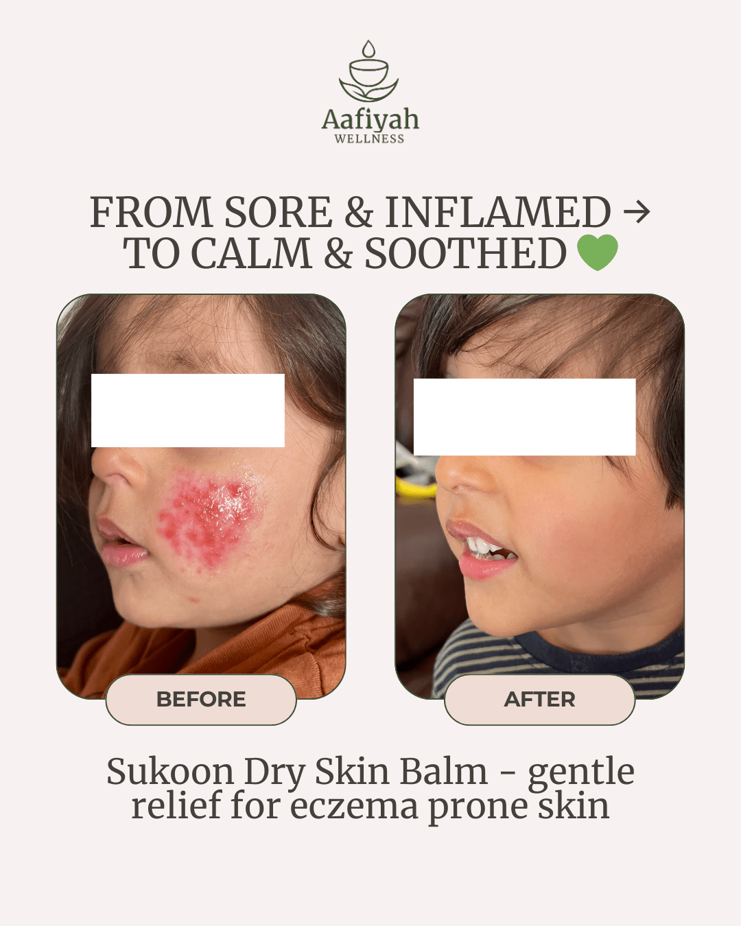 Sukoon Dry Skin Relief Balm - Aafiyah Wellness Clinic